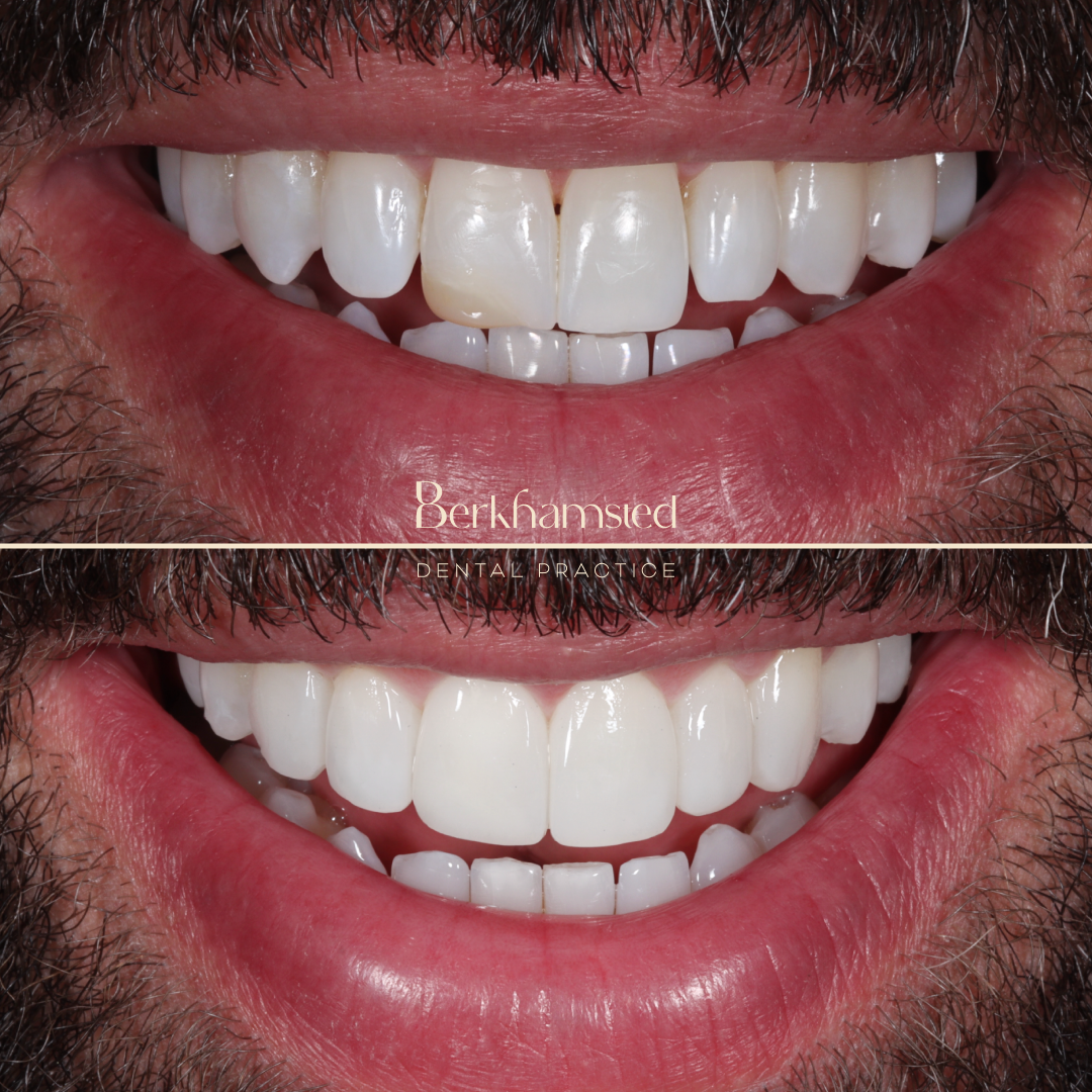 Smile Gallery - Berkhamsted Dental Practice