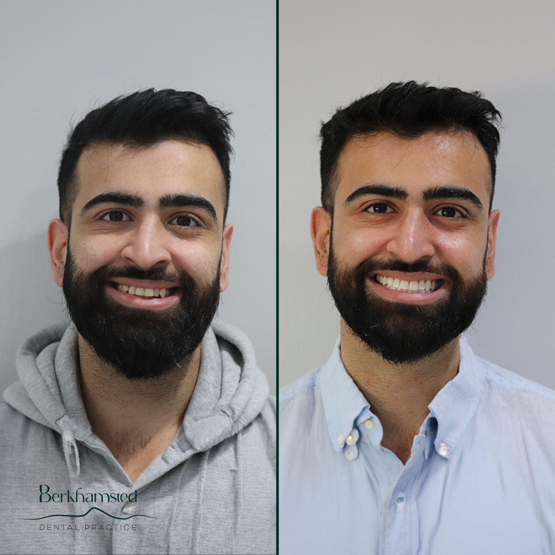 Smile Gallery - Berkhamsted Dental Practice