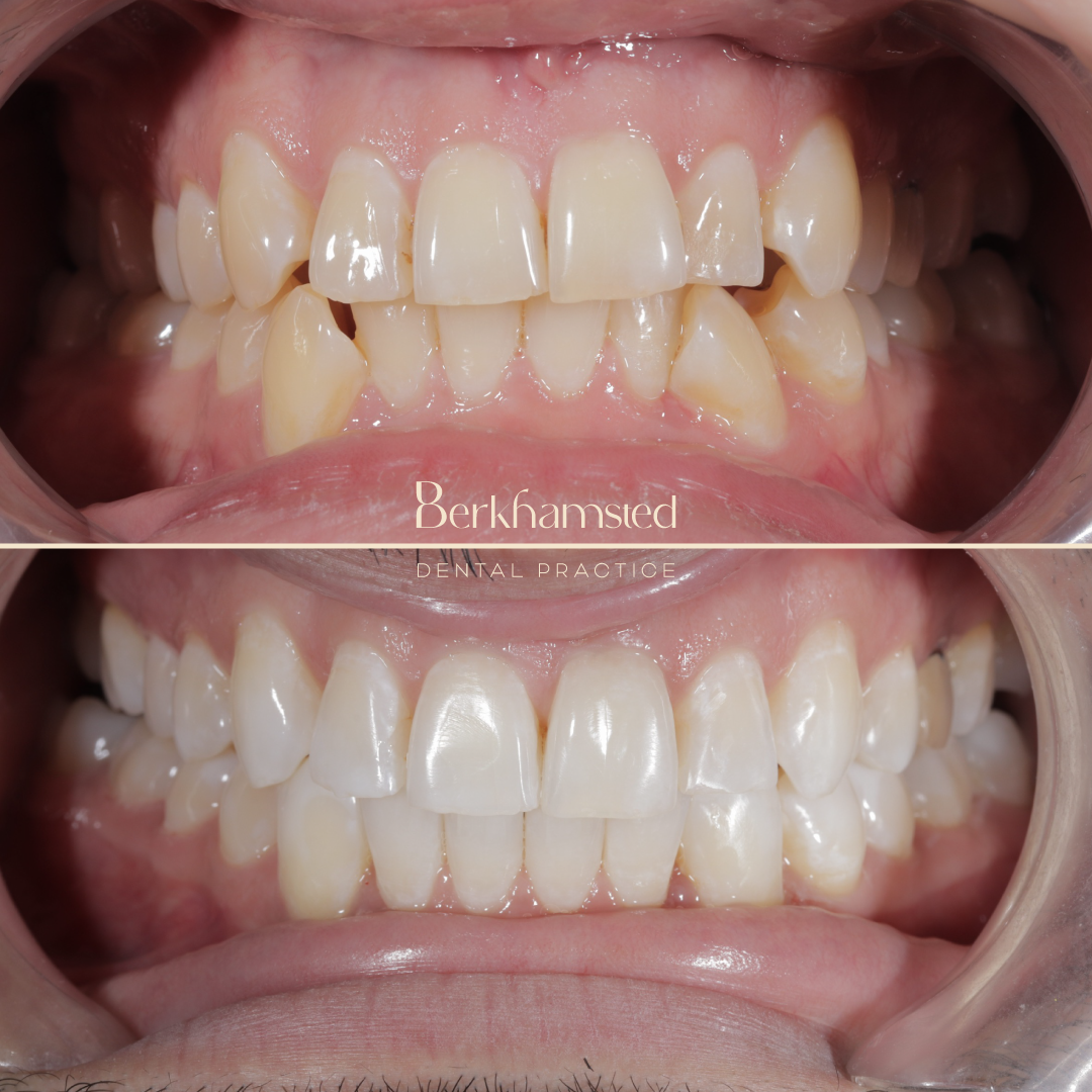 Smile Gallery - Berkhamsted Dental Practice