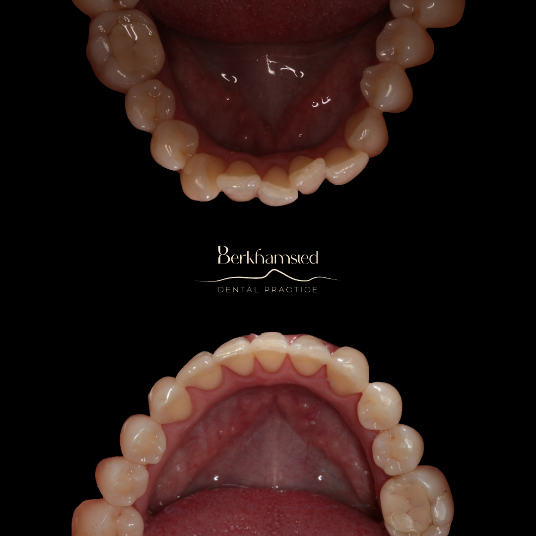 Smile Gallery - Berkhamsted Dental Practice