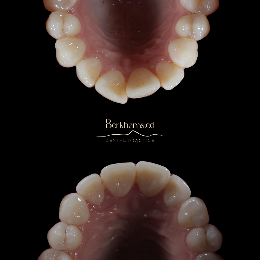 Smile Gallery - Berkhamsted Dental Practice