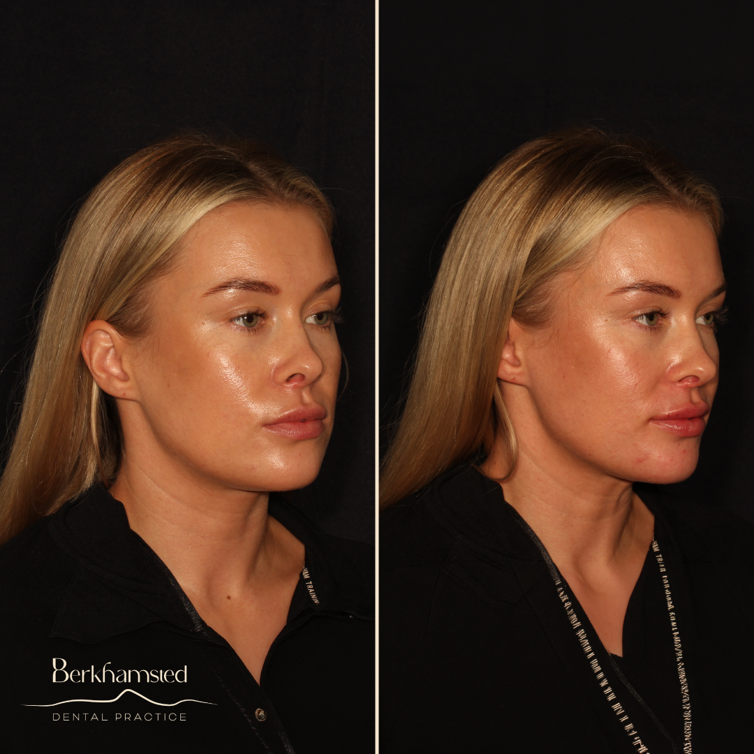Smile Gallery - Berkhamsted Dental Practice