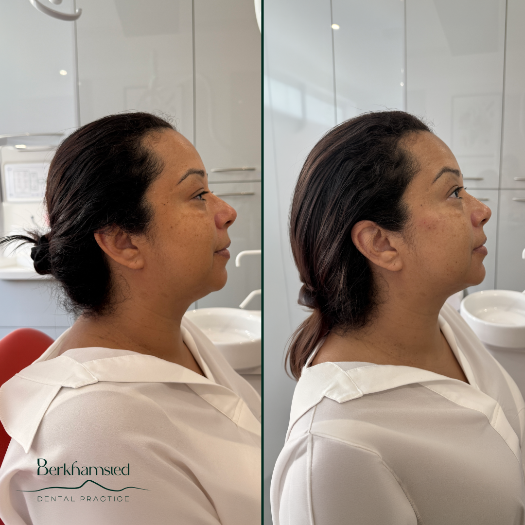 Smile Gallery - Berkhamsted Dental Practice