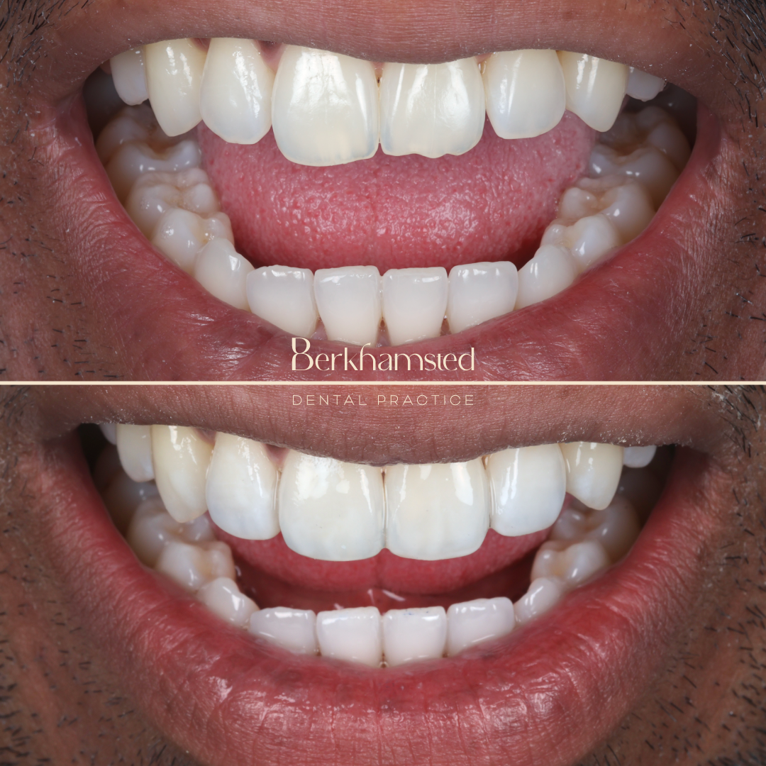 Smile Gallery - Berkhamsted Dental Practice