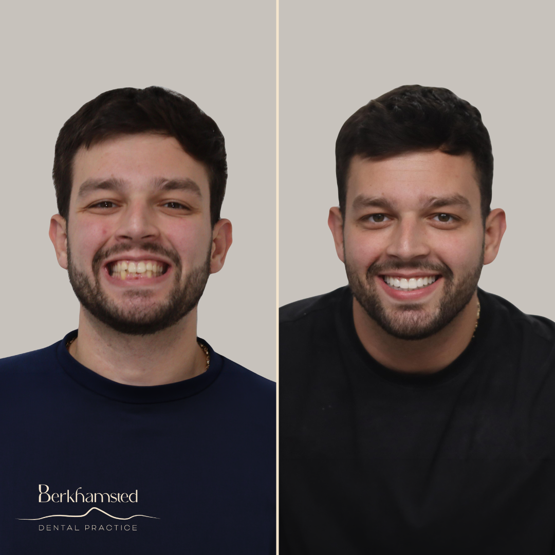Smile Gallery - Berkhamsted Dental Practice
