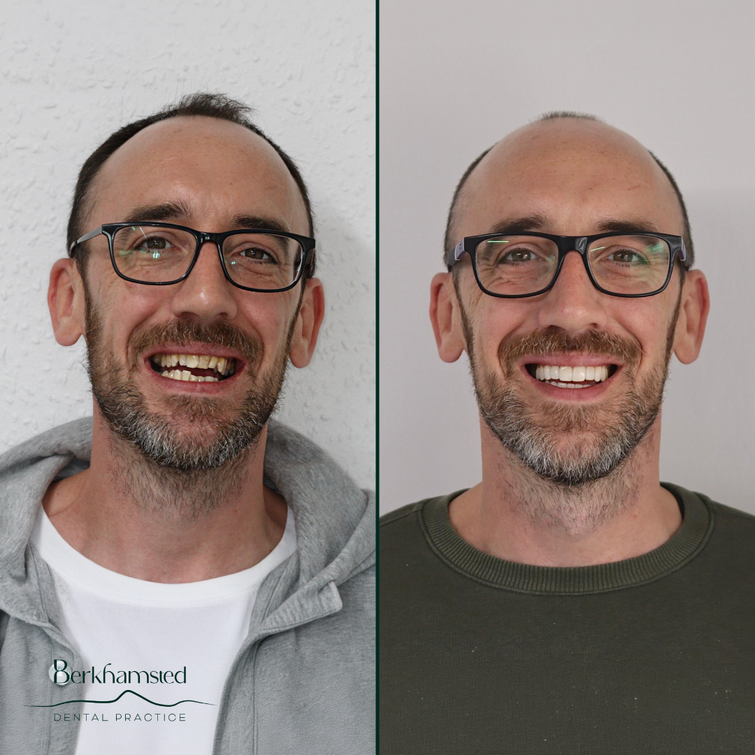 Smile Gallery - Berkhamsted Dental Practice