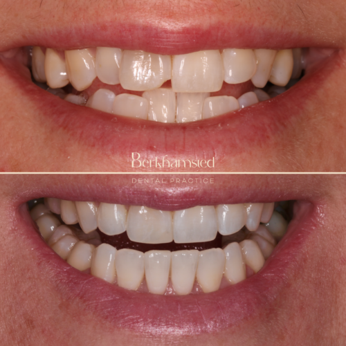 Smile Gallery - Berkhamsted Dental Practice