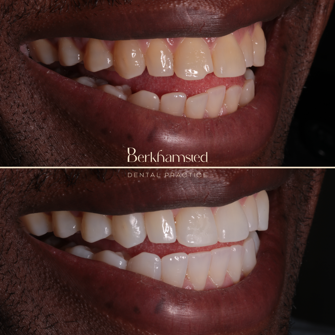 Smile Gallery - Berkhamsted Dental Practice