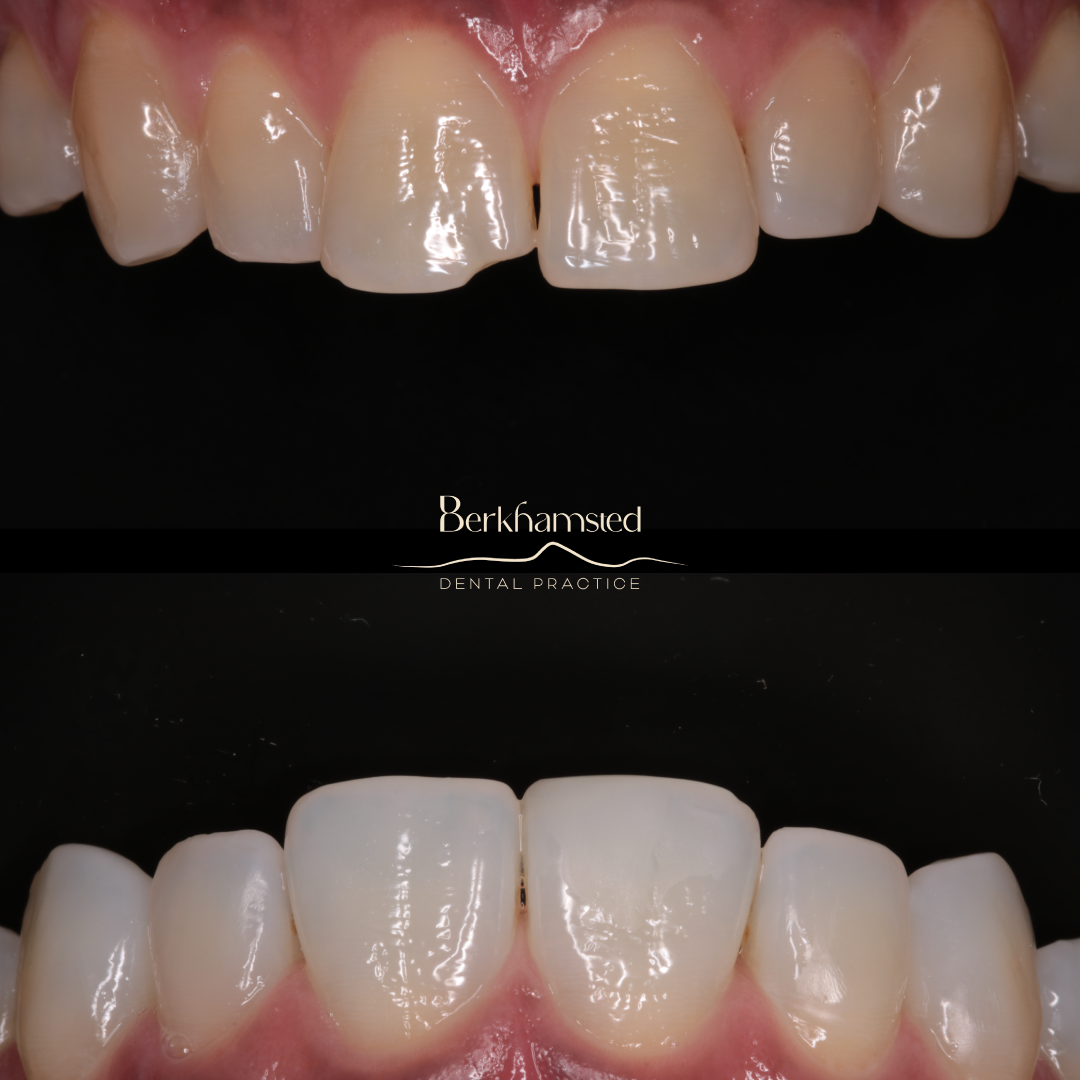 Smile Gallery - Berkhamsted Dental Practice