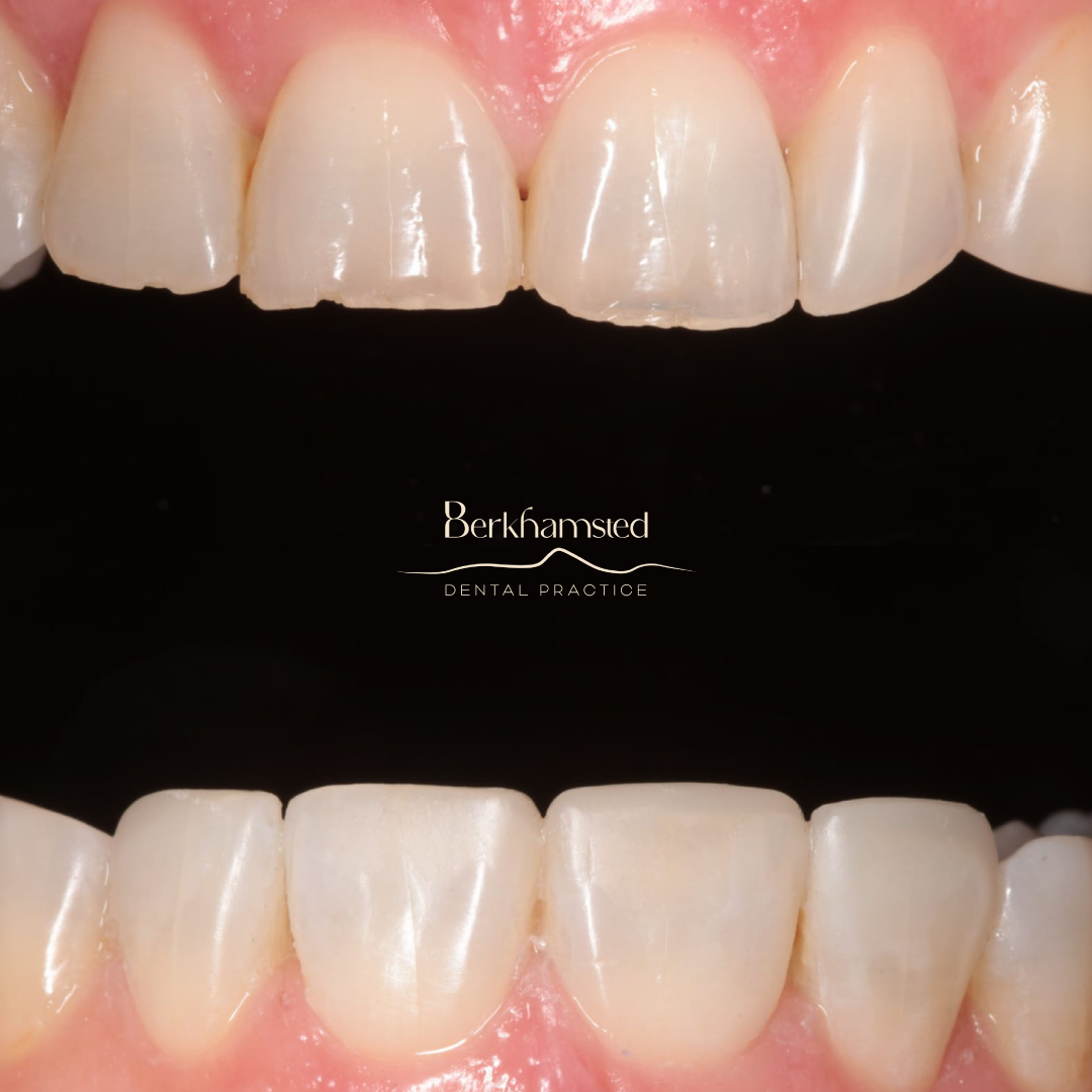 Smile Gallery - Berkhamsted Dental Practice