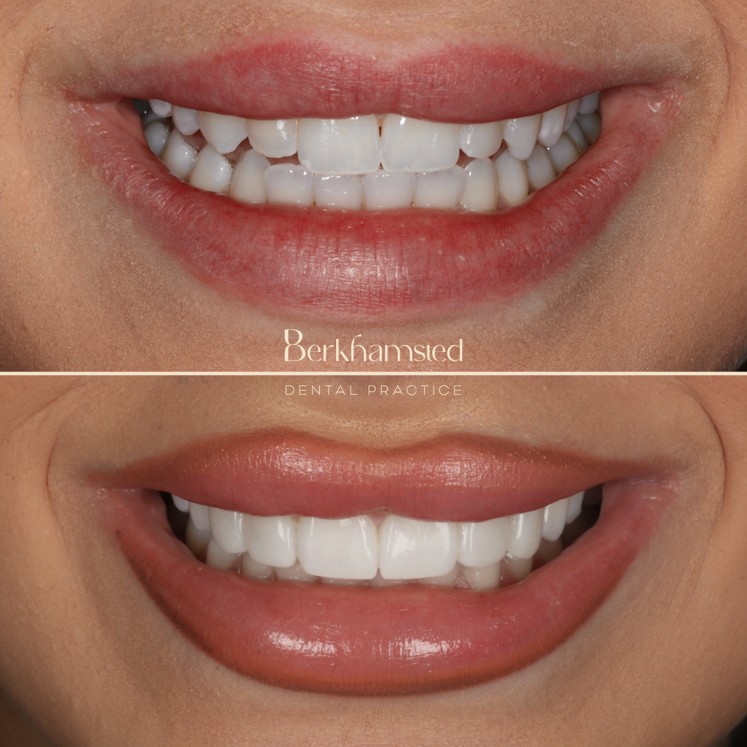 Smile Gallery - Berkhamsted Dental Practice