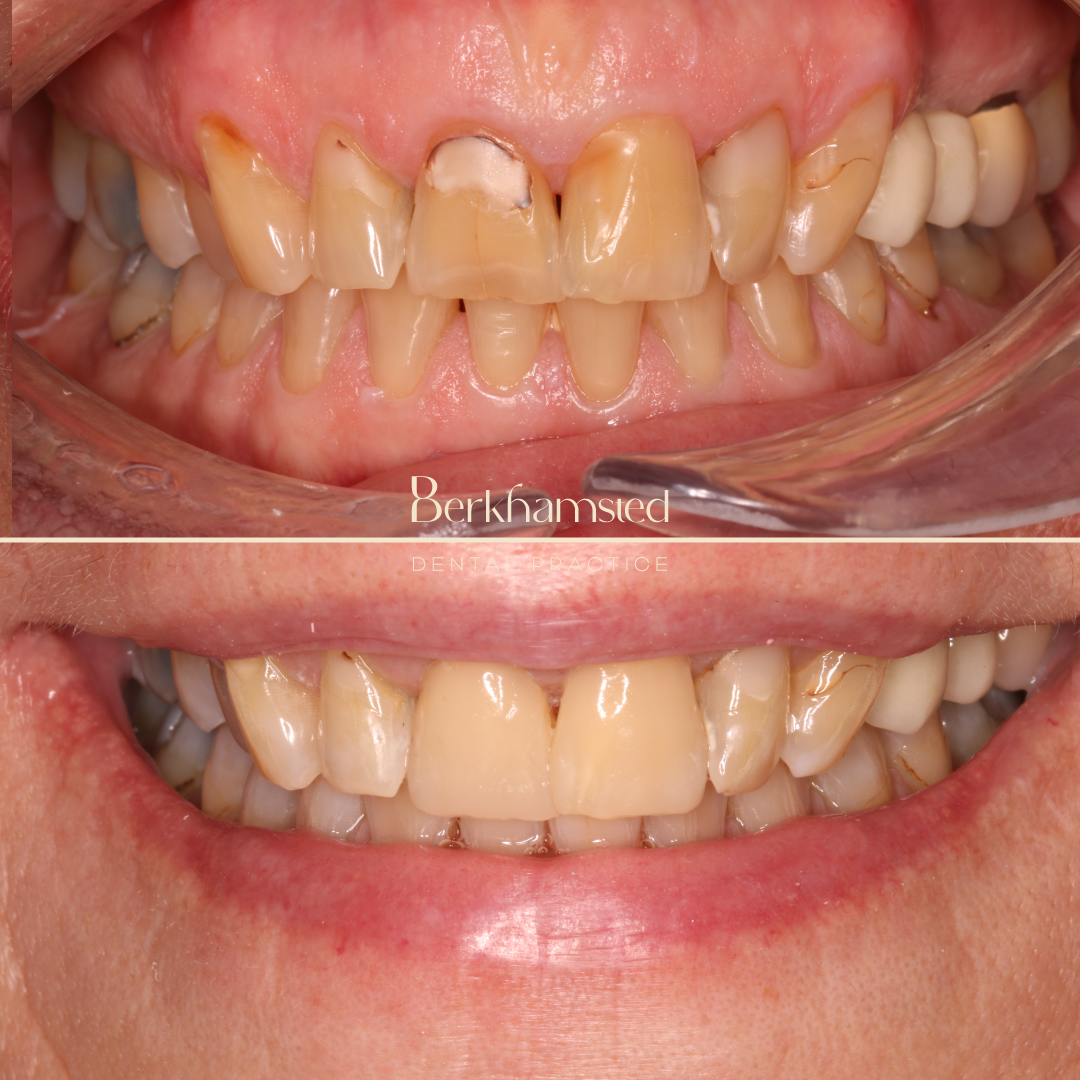 Smile Gallery - Berkhamsted Dental Practice