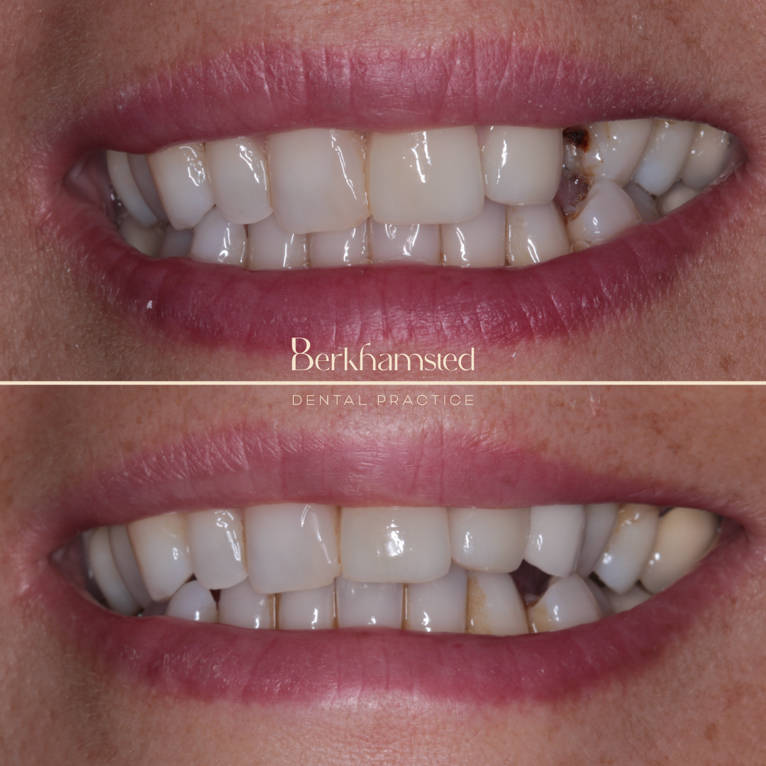Smile Gallery - Berkhamsted Dental Practice