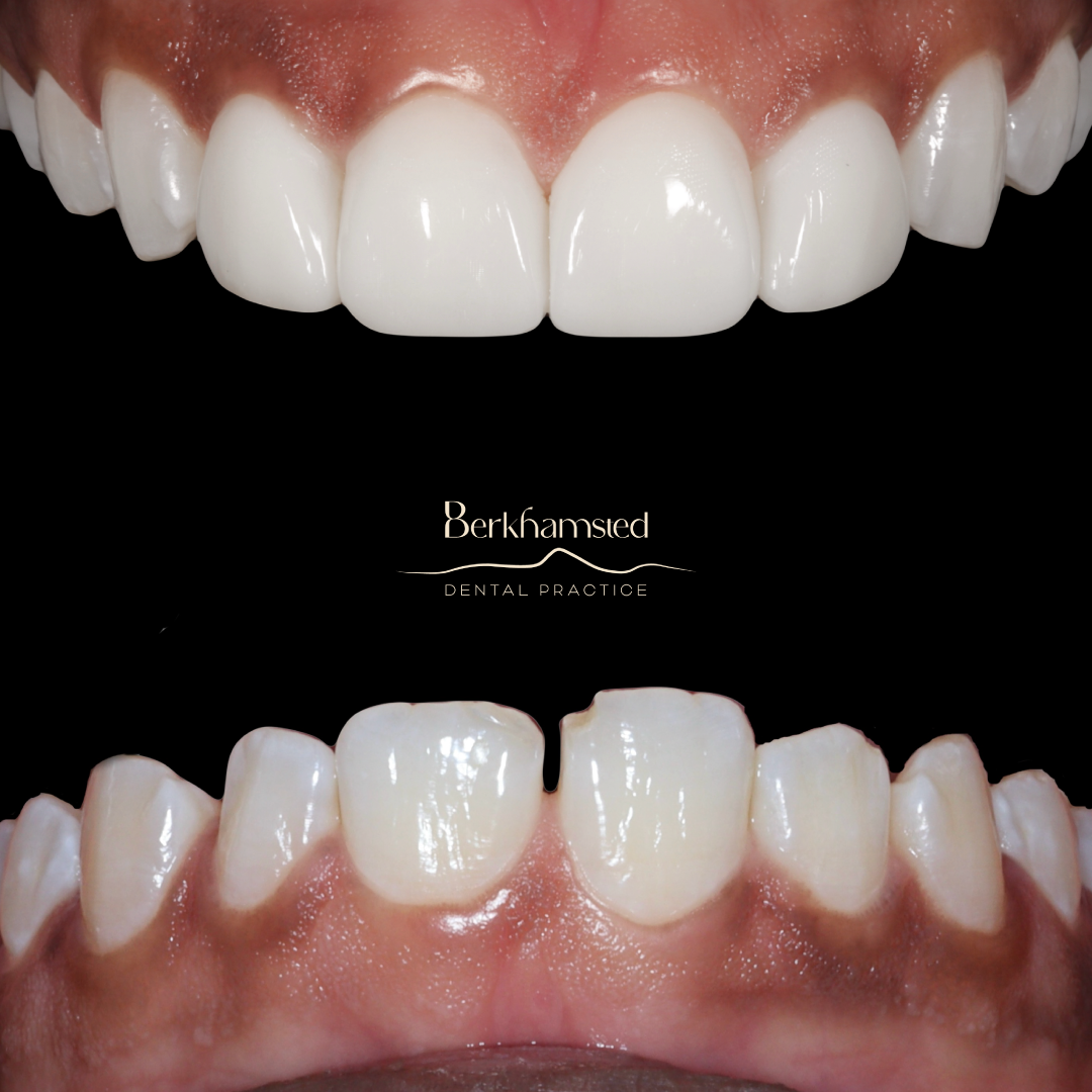 Smile Gallery - Berkhamsted Dental Practice