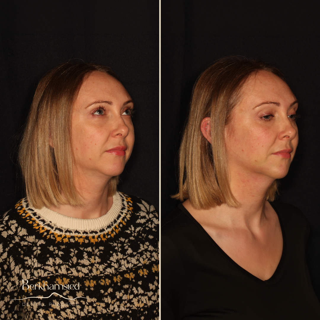 Smile Gallery - Berkhamsted Dental Practice