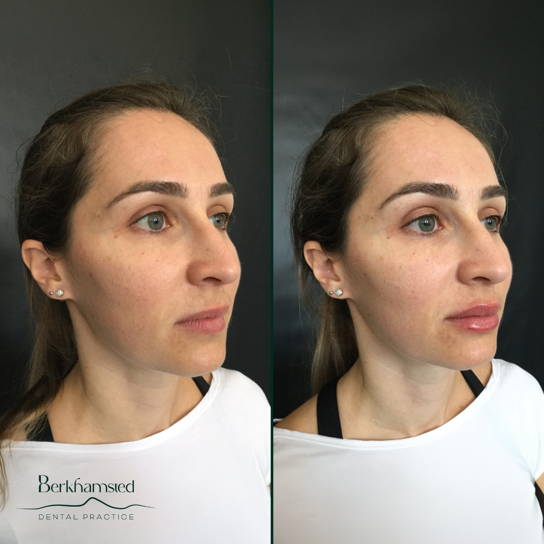 Smile Gallery - Berkhamsted Dental Practice