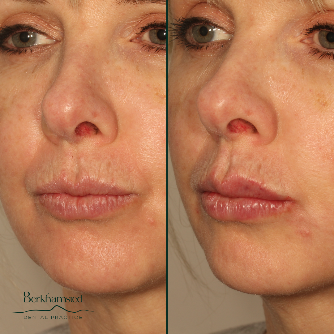 Smile Gallery - Berkhamsted Dental Practice