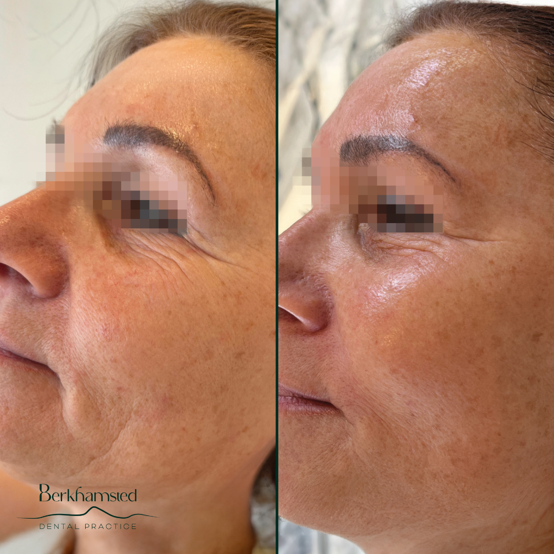 Smile Gallery - Berkhamsted Dental Practice