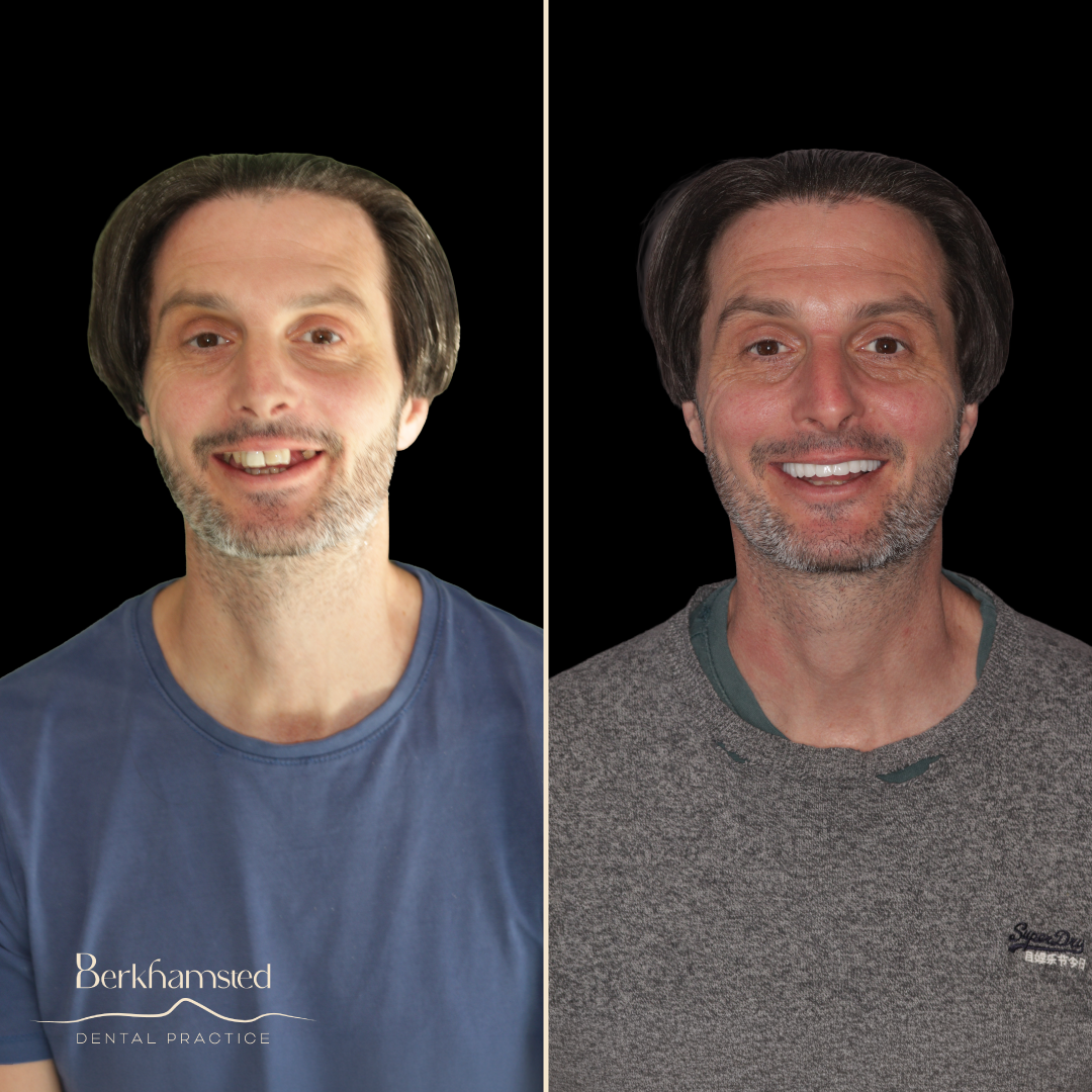 Smile Gallery - Berkhamsted Dental Practice