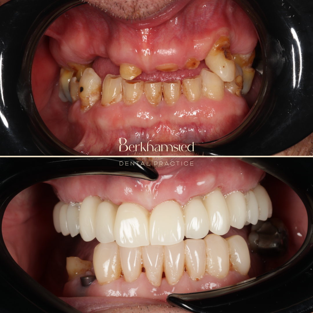 Smile Gallery - Berkhamsted Dental Practice