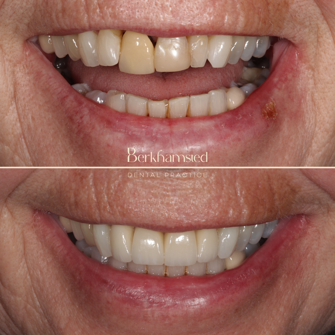 Smile Gallery - Berkhamsted Dental Practice
