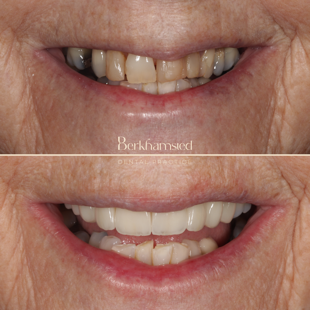 Smile Gallery - Berkhamsted Dental Practice