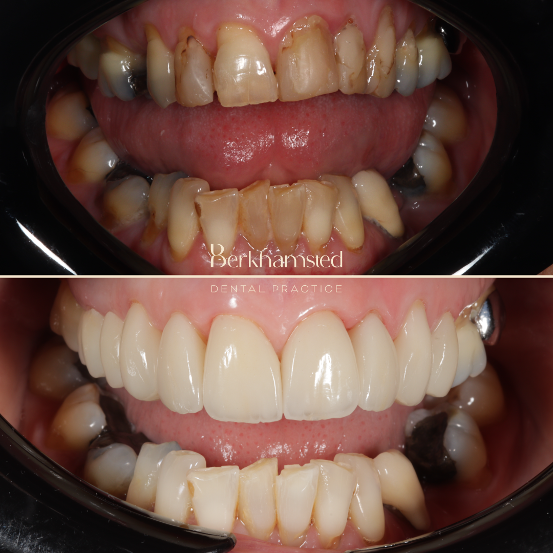 Smile Gallery - Berkhamsted Dental Practice