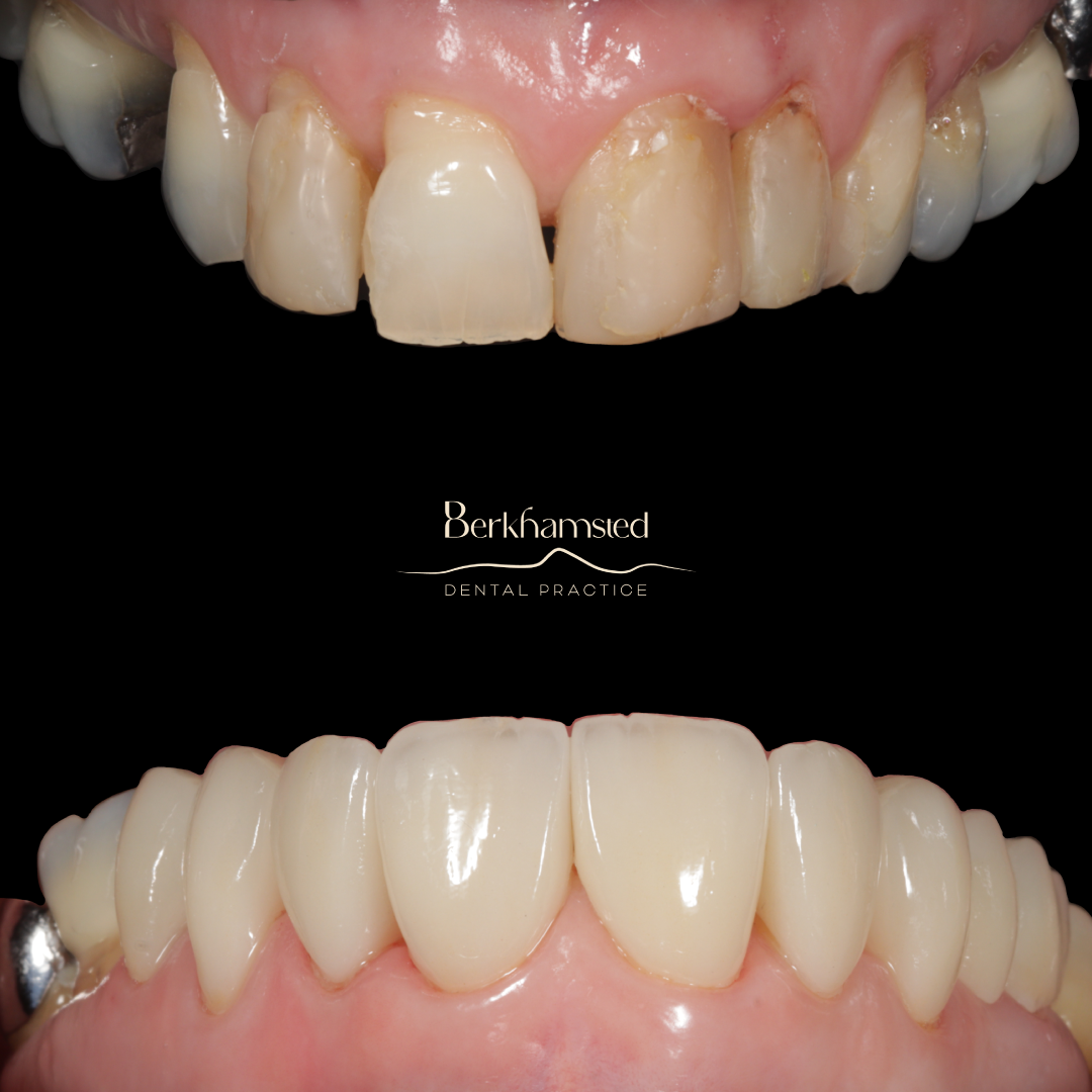 Smile Gallery - Berkhamsted Dental Practice