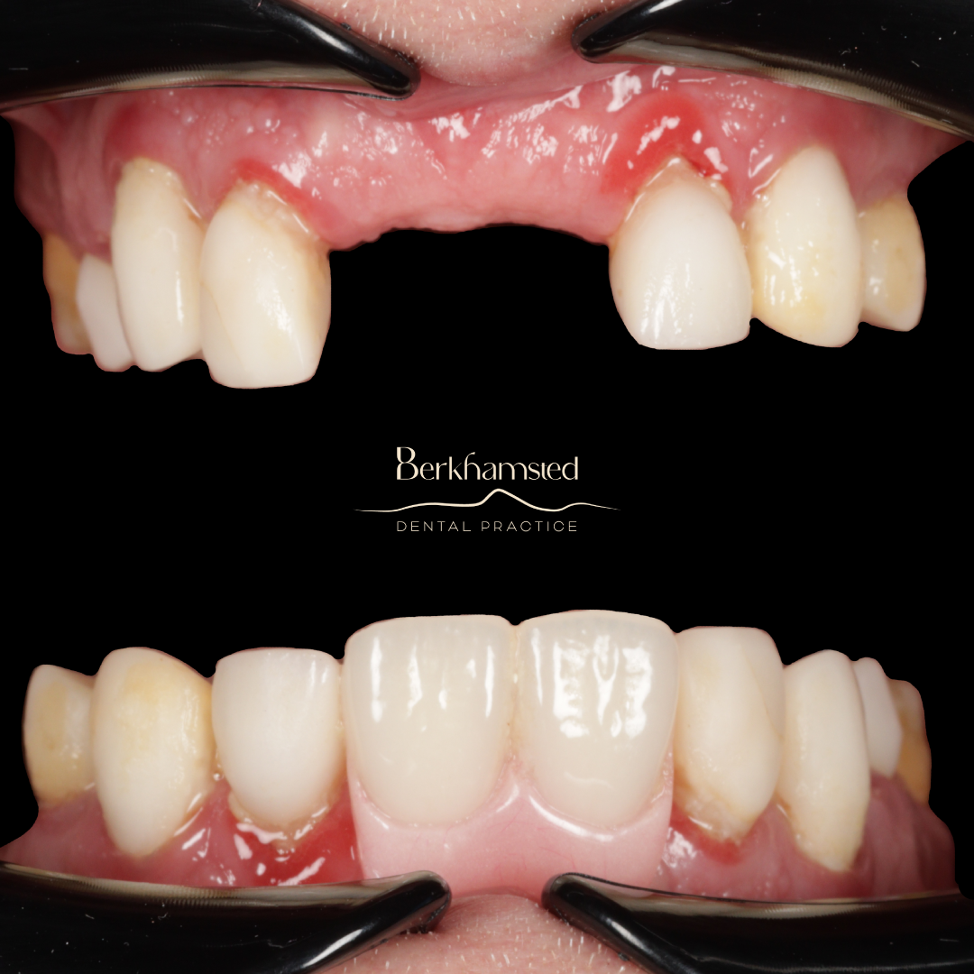 Smile Gallery - Berkhamsted Dental Practice