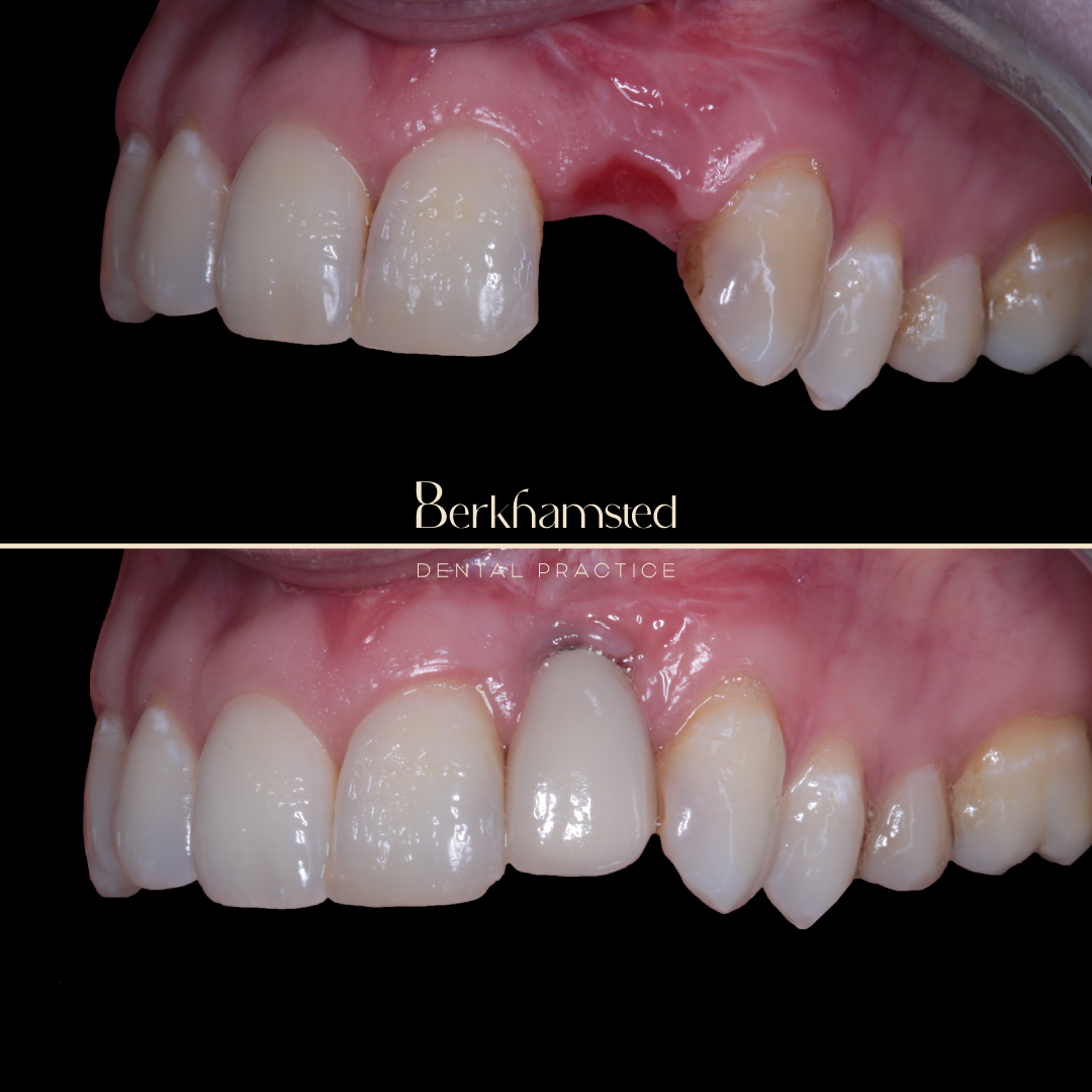 Smile Gallery - Berkhamsted Dental Practice