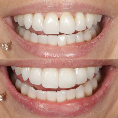 Smile Gallery - Berkhamsted Dental Practice