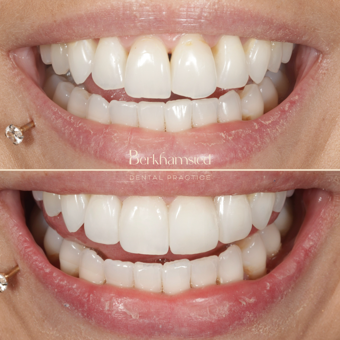 Smile Gallery - Berkhamsted Dental Practice