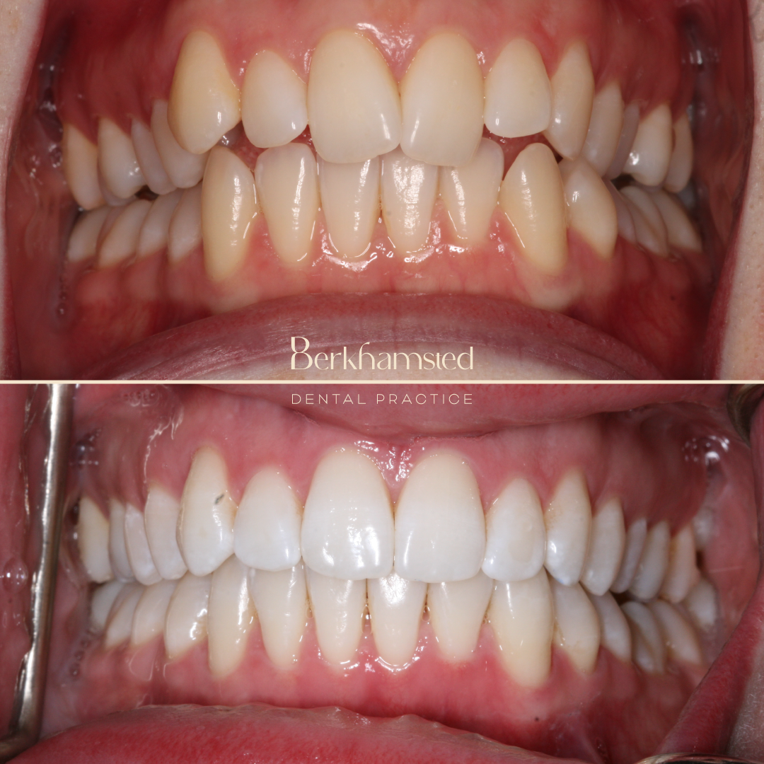 Smile Gallery - Berkhamsted Dental Practice