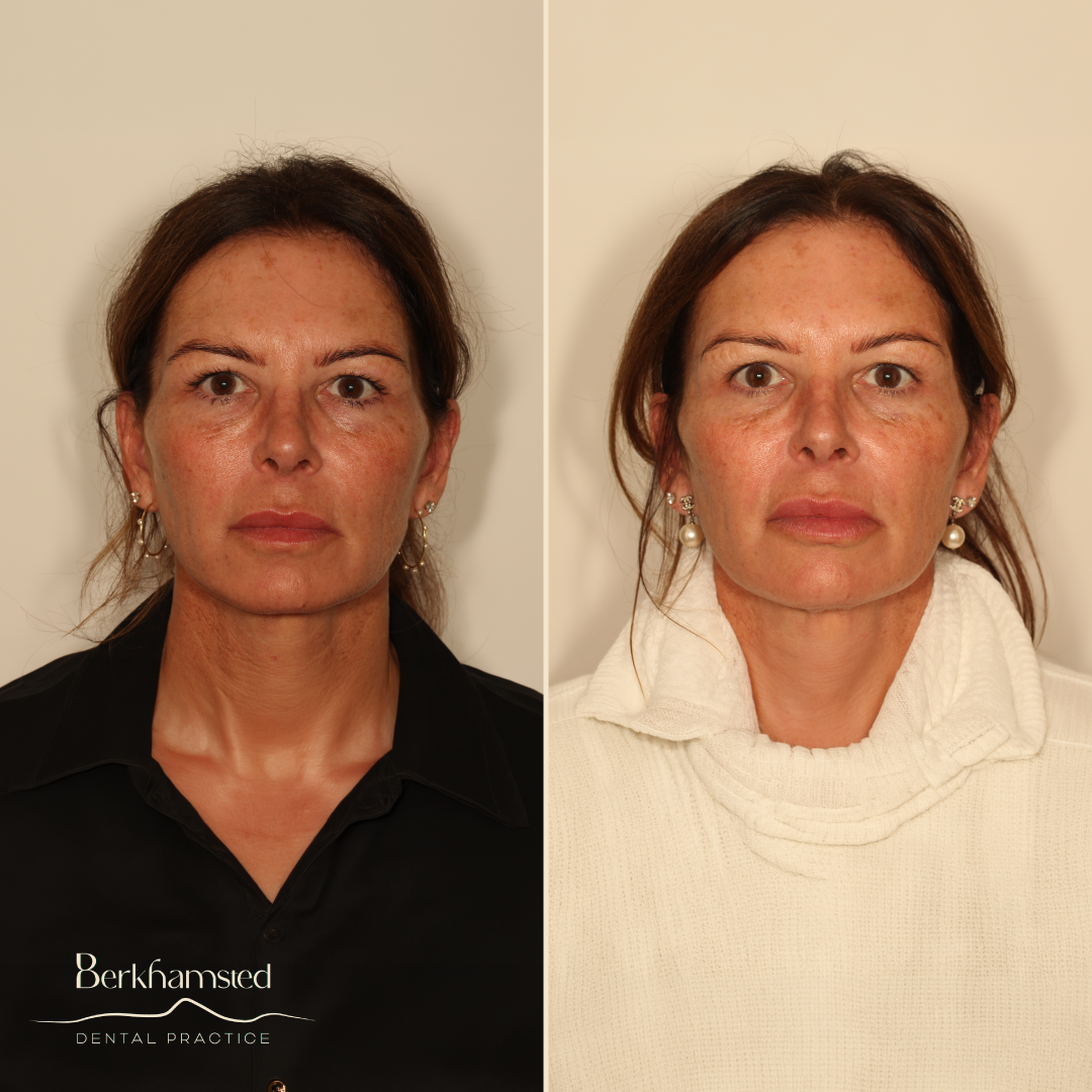 Smile Gallery - Berkhamsted Dental Practice
