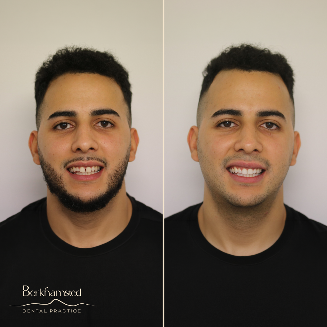 Smile Gallery - Berkhamsted Dental Practice