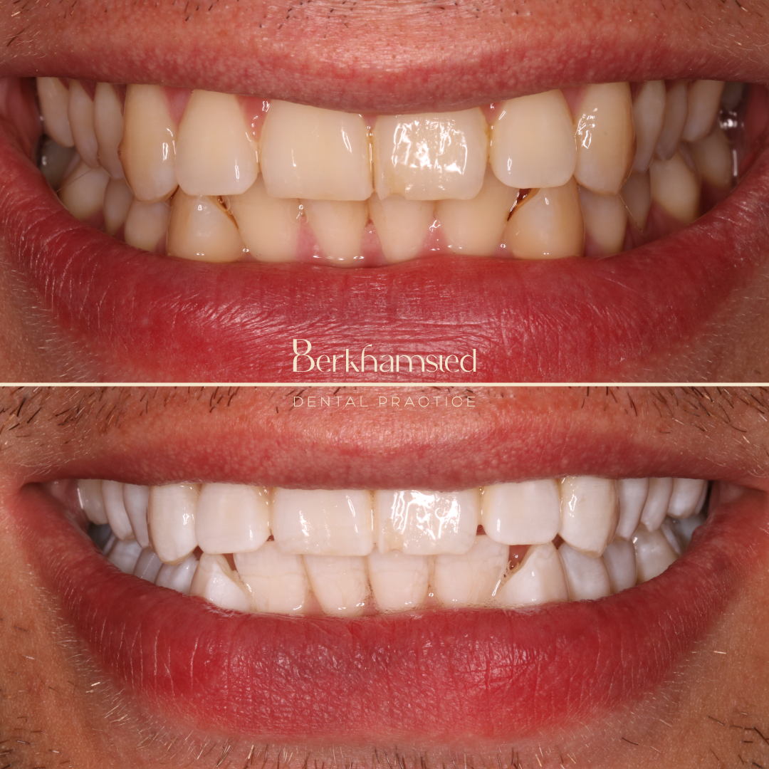 Smile Gallery - Berkhamsted Dental Practice