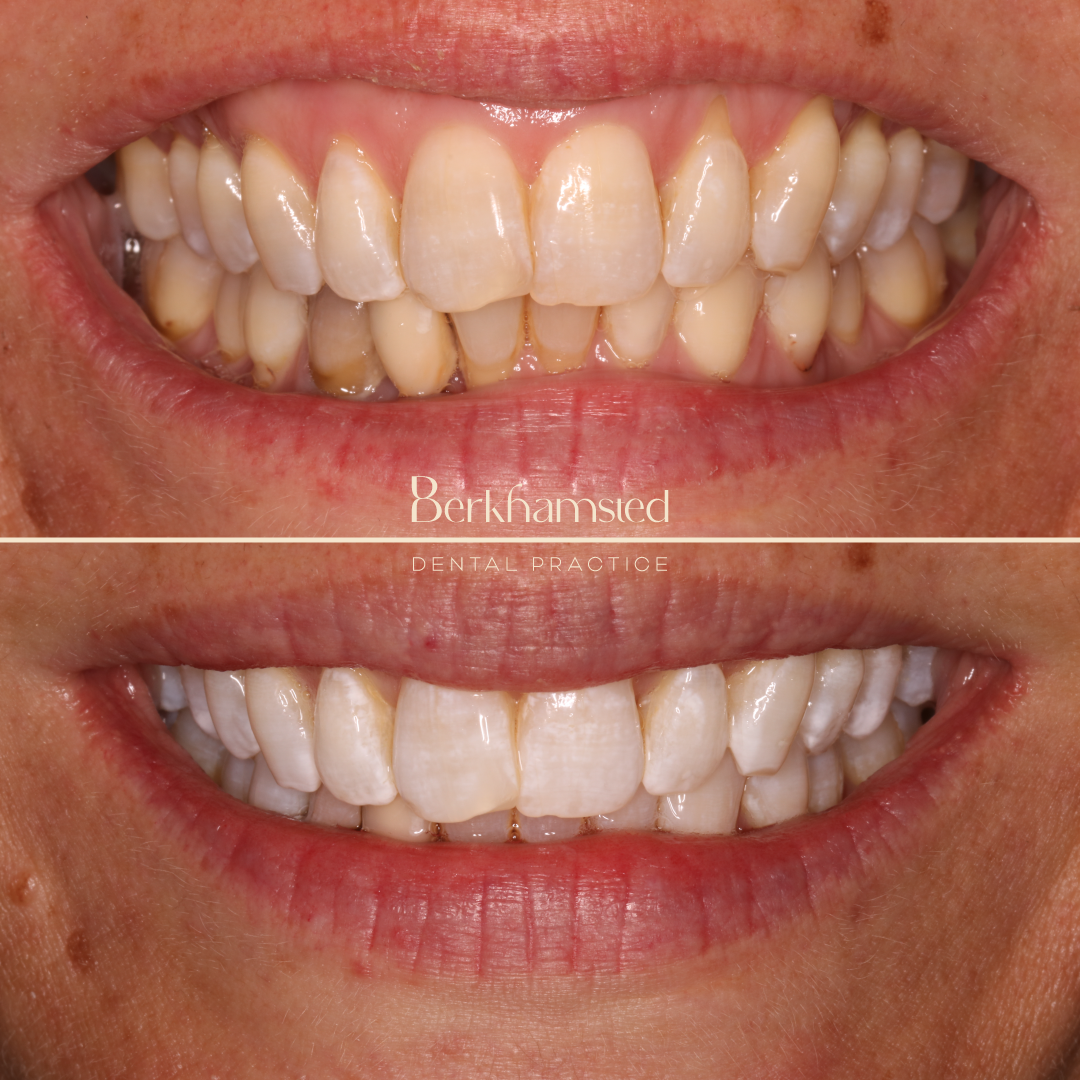 Smile Gallery - Berkhamsted Dental Practice