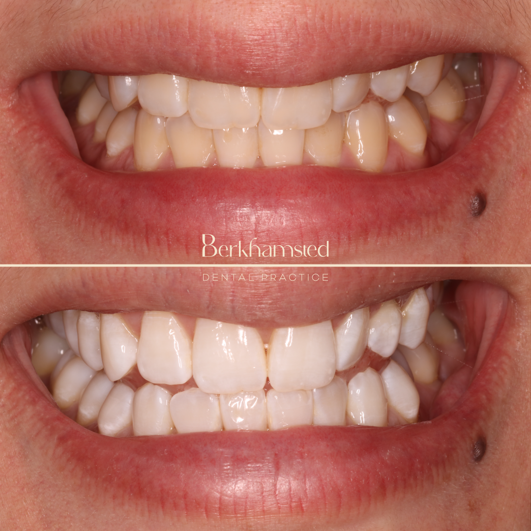 Smile Gallery - Berkhamsted Dental Practice
