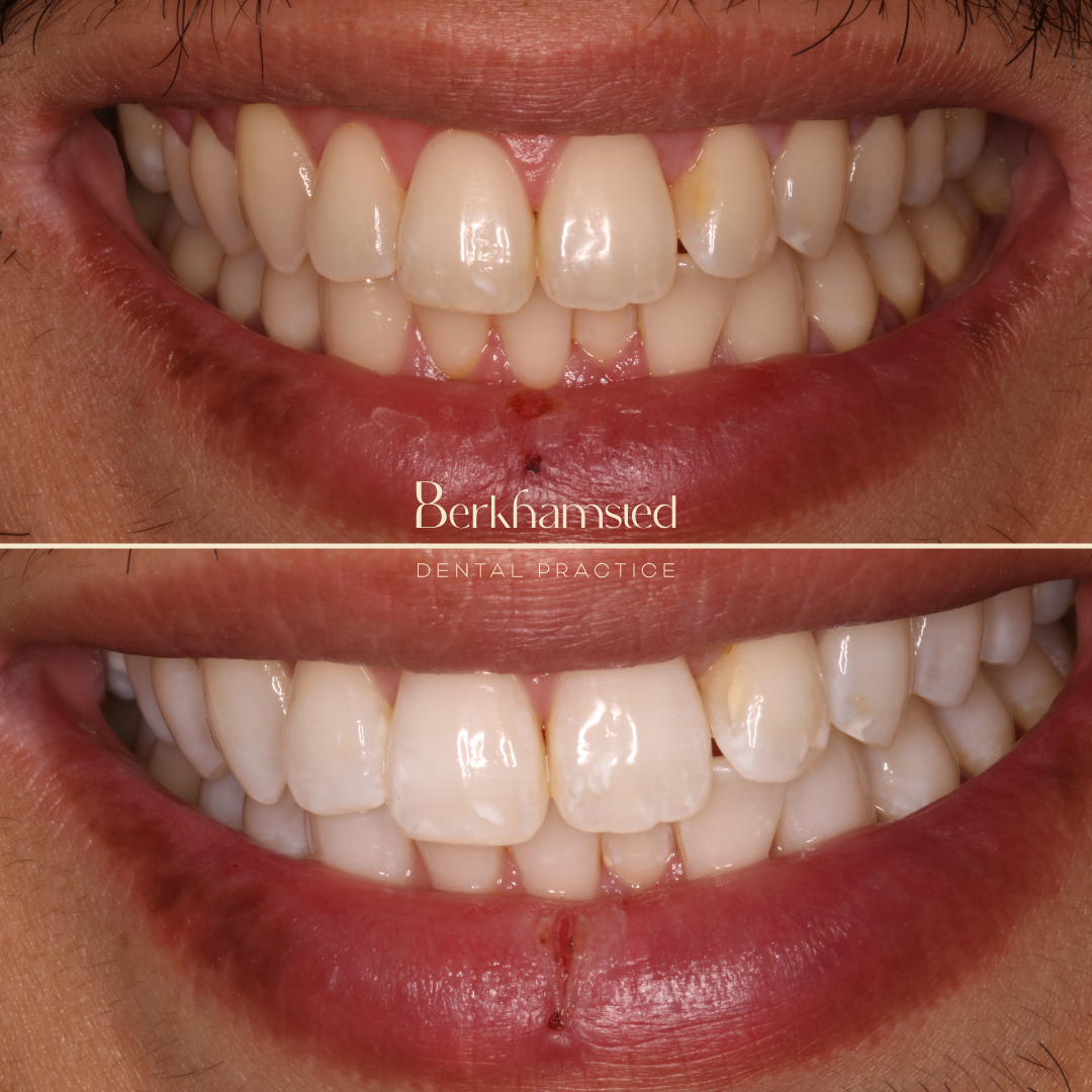 Smile Gallery - Berkhamsted Dental Practice