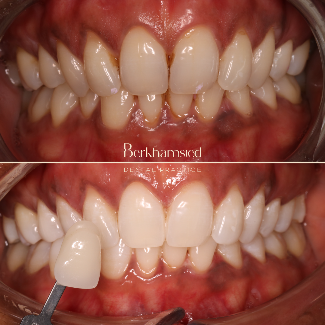 Smile Gallery - Berkhamsted Dental Practice