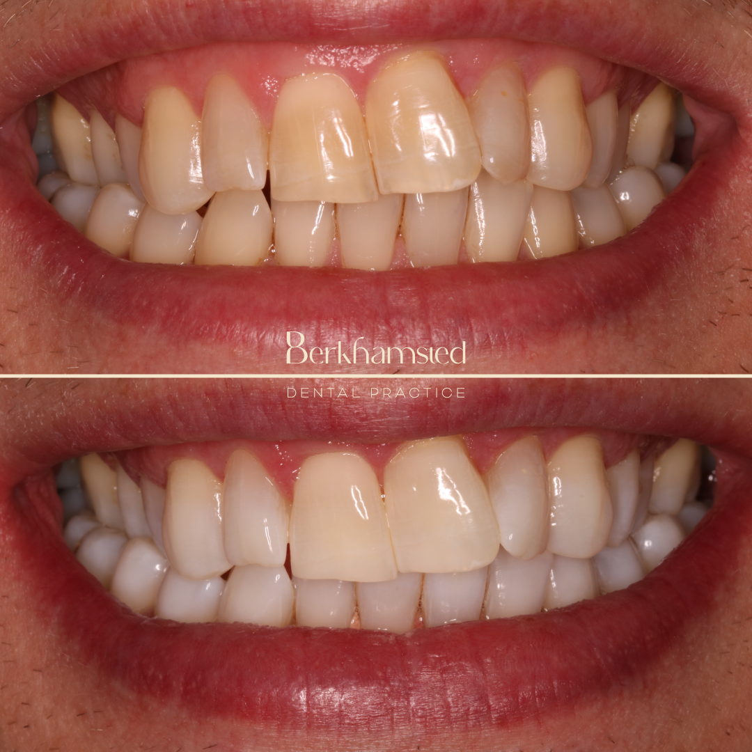 Smile Gallery - Berkhamsted Dental Practice
